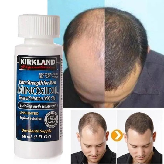 Minoxidil 5 % - un traitement efficace de la perte de cheveux