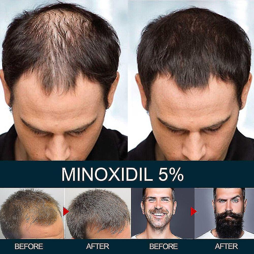 Minoxidil 5 % - un traitement efficace de la perte de cheveux